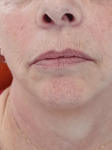 Preenchimento labial