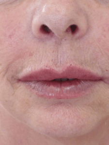 preenchimento labial em jundiai